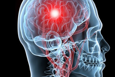 Medulloblastom - Ursachen, Symptome und Behandlung
