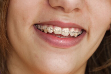 Zahnspangen - Funktion, Anwendungsgebiete und Arten