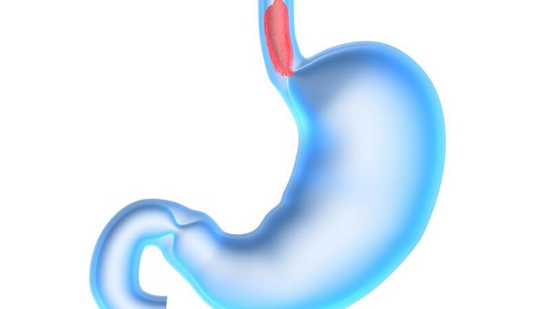 Bei einer Ösophagusatresie besteht entweder keine Verbindung zwischen Speiseröhre und Magen, oder aber die Speiseröhre weist eine starke Verengung auf