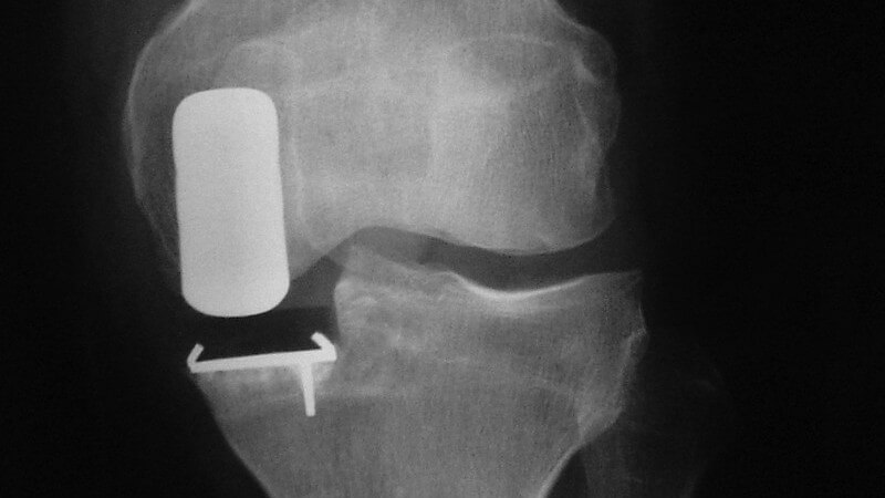 Wissenswertes zur Osteosynthese