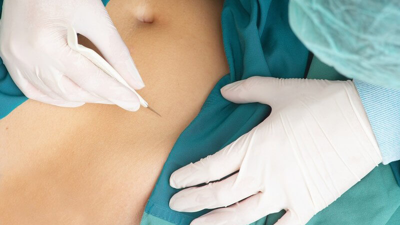 Die Behandlung erfolgt mitunter im Rahmen einer Laparotomie oder Laparoskopie