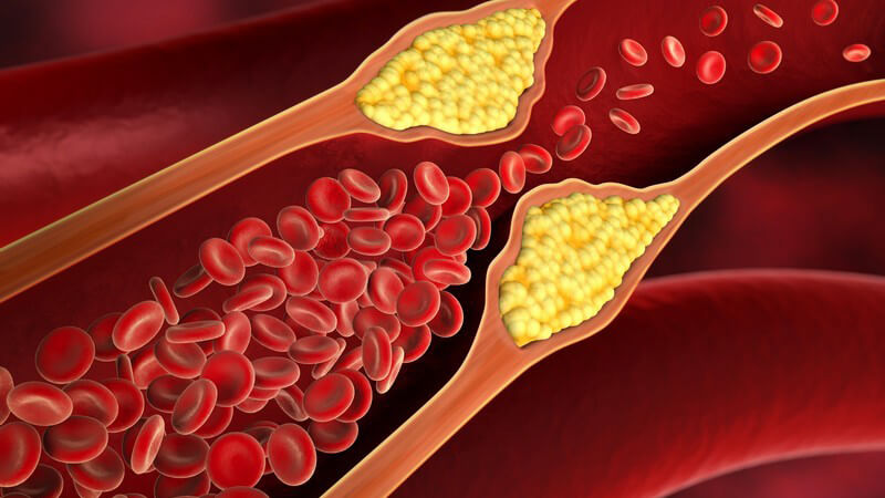 Wissenswertes zum Nierenarterienaneurysma