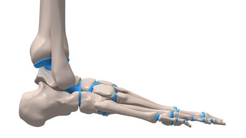 Umknicken, Knochenbrüche oder Schäden der Bänder können eine Sprunggelenksarthrose auslösen