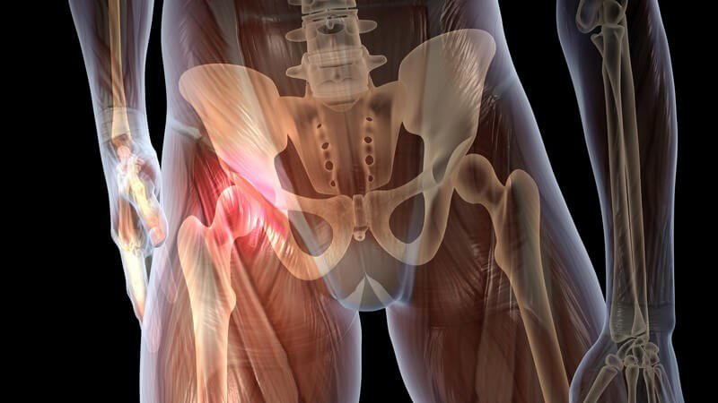 Meist handelt es sich bei der Kreuzbein-Darmbeingelenksarthrose um die Folge einer Beckenverletzung