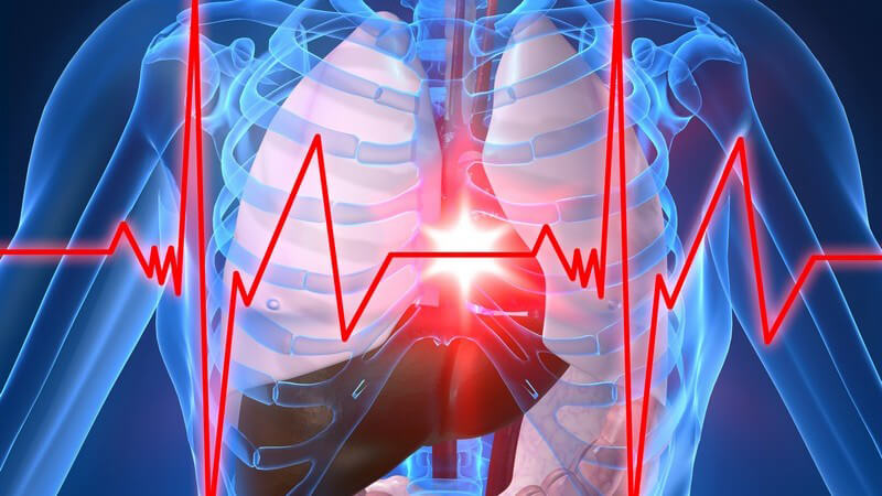 Schmerzen hinter dem Brustbein sowie Engegefühle in der Brust sind Anzeichen einer stabilen Angina pectoris