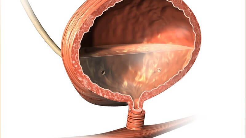 Eine mögliche Ursache der Hunner-Zystitis können frühere Blasenerkrankungen sein