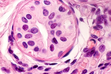 Exzision und Kürettage - das Herausschneiden oder Absaugen der Schweißdrüsen