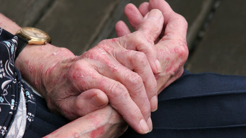 Andere Hauterkrankungen, aber auch äußere Faktoren, können das Hand- und Fußekzem auslösen