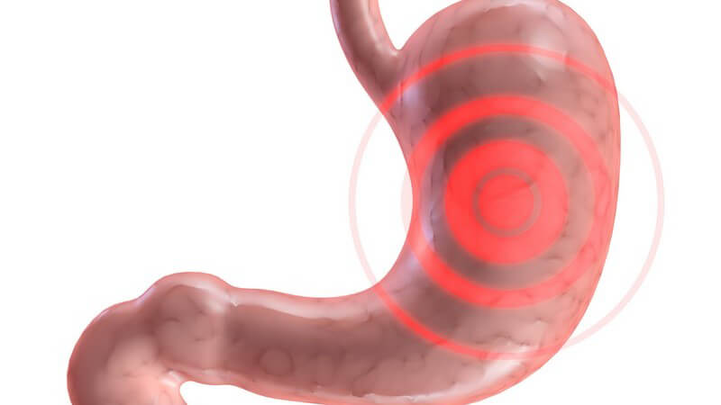 Bei der A-Gastritis wird die Magenschleimhaut durch den eigenen Organismus angegriffen
