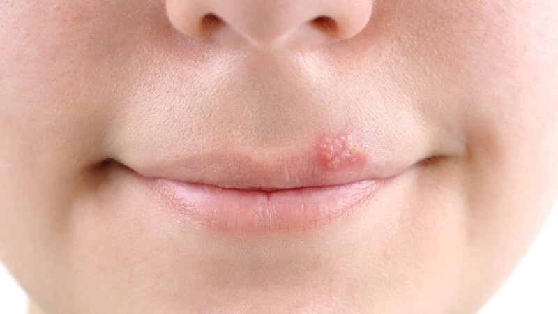 Deutliche Symptome des Herpes labialis zeigen sich bei nur etwa einem Prozent der Betroffenen