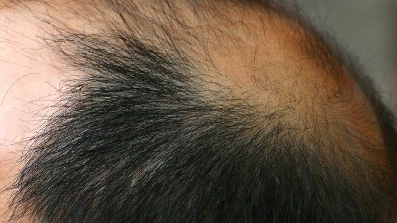 Beim kreisrunden Haarausfall handelt es sich um eine entzündliche Erkrankung, deren Ursache unklar ist