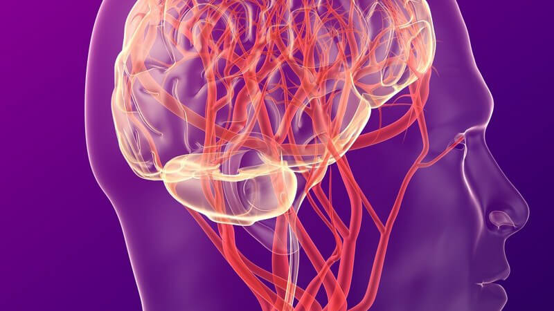 Beim hämorrhagischen Infarkt kommt es zur Bildung eines Hämatoms im Gehirngewebe