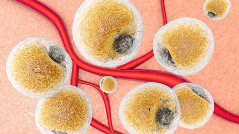 Es liegt ein Defekt des lysosomalen Enzyms Glukozerebrosidase vor