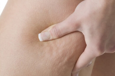 Bauch, Beine, Po: Tipps zur inneren und äußerlichen Behandlung einer Bindegewebsschwäche