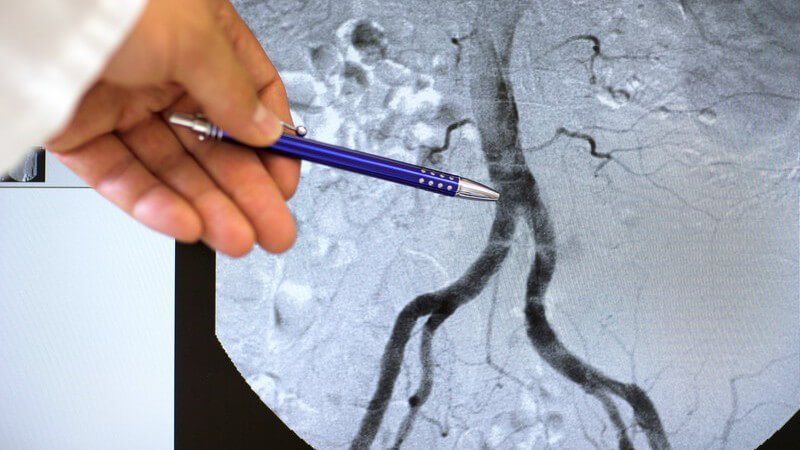 Im Rahmen einer Perkutanen Transluminalen Coronaren Angioplastie wird ein Ballonkatheter eingesetzt