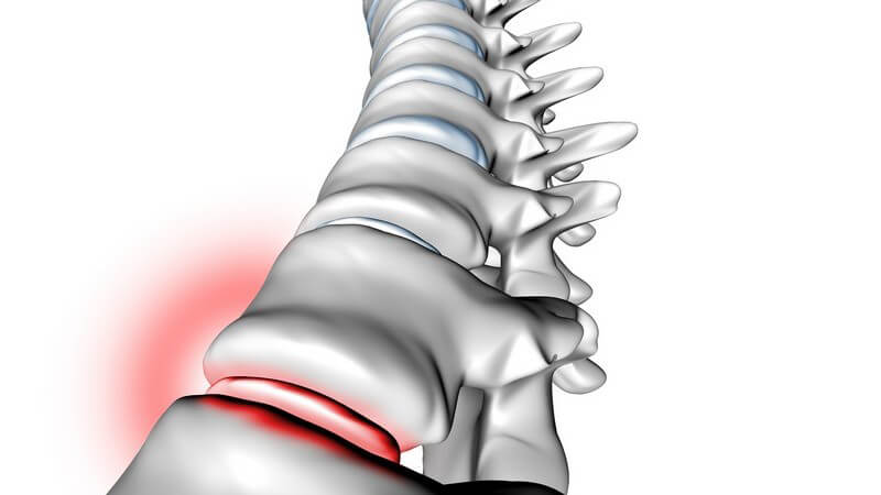 Muskelverspannungen und Bandscheibenvorfälle gelten als mögliche Ursachen