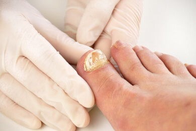 Nagelprobleme: Was kann ich tun?