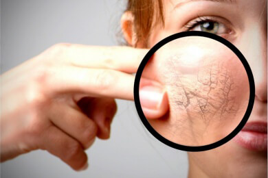 Couperose - Ursachen, Symptome und Wirkstoffe zur Behandlung