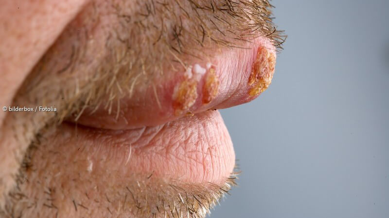 Genitalis anzeichen herpes Herpes genitalis: