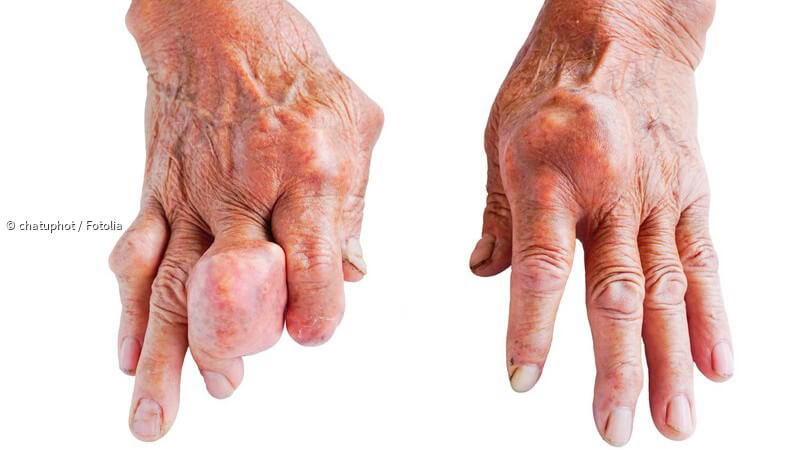 ᐅ Gicht - Ursachen, Symptome und Behandlung