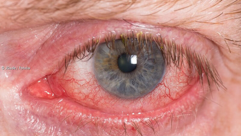 ᐅ Bindehautentzündung - Ursachen, Formen, Symptome und Behandlung