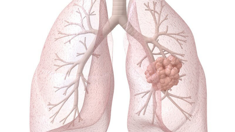 Die Entstehung von Lungenkrebs und wie man das Bronchialkarzinom erkennen und behandeln kann