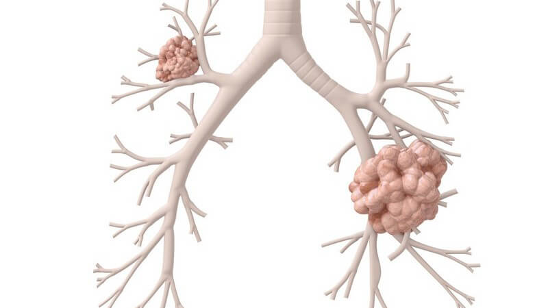 Durch die Bildung von Tochtergeschwülsten verschlechtern sich die Heilungschancen deutlich