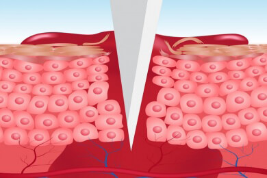 Blutungszeit: Funktion und Durchführung