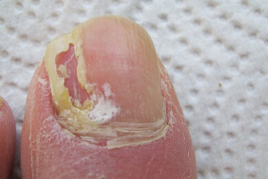 Fußpilz - Ursachen, Symptome und Behandlung