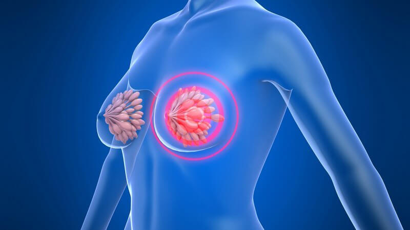 Die Entstehung des duktalen Mammakarzinom, der häufigsten Form von Brustkrebs und wie man ihn erkennen und behandeln kann