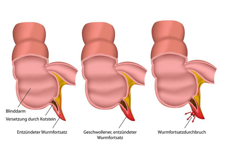 ᐅ Blinddarmdurchbruch - Die Appendix-Ruptur gilt als schwers
