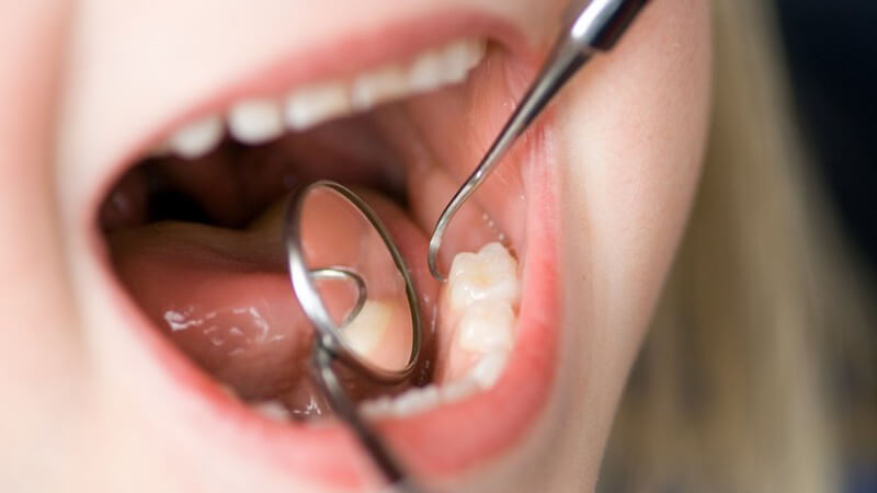Vor Anwendung des Sandstrahlverfahrens müssen die kariösen Stellen am Zahn mechanisch entfernt werden