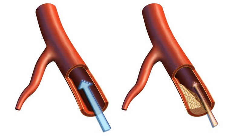 Primäre Lipidstoffwechselstörungen sind angeboren, während die sekundäre Art meist durch Erkrankungen entsteht