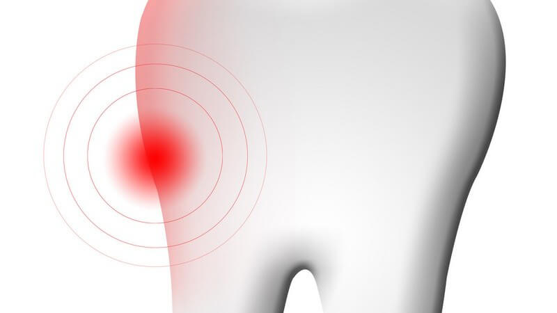 In den meisten Fällen wird die Zahnnerventzündung durch Karies ausgelöst