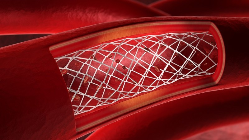 Ablauf, Ziel und Zweck sowie mögliche Risiken und Komplikationen einer Angiographie der Herzkranzgefäße
