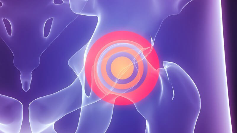 Beim Enge-Syndrom unterscheidet man zwischen Nockenwellen-Impingement und Pincer-Impingement bzw. Beißzangen-Impingement