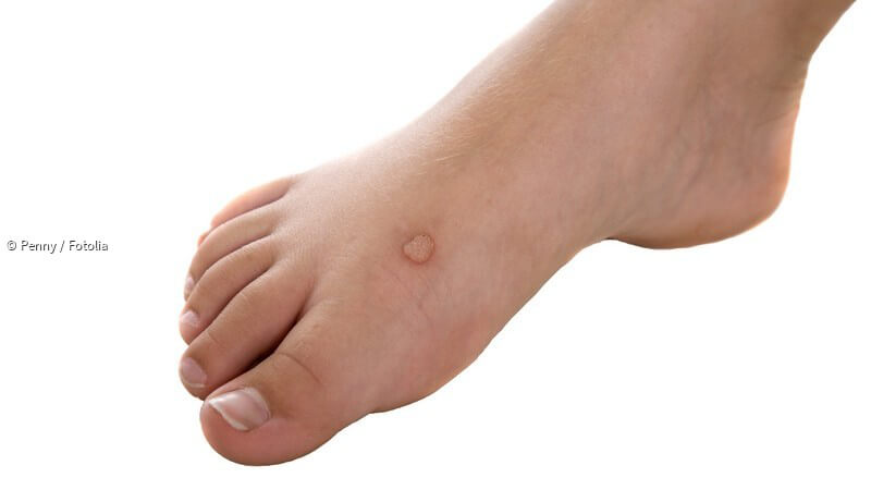 Fuß entfernen unterm dornwarze Dornwarzen entfernen: