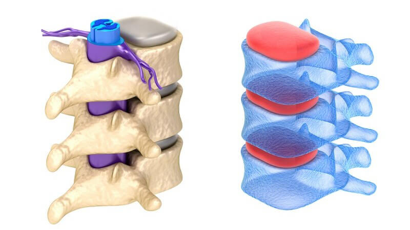 Wissenswertes zur spinalen Stenose