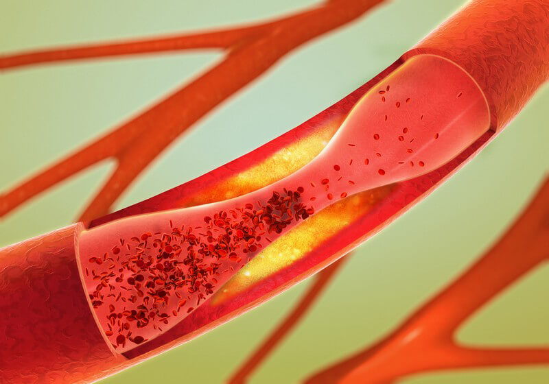 Hämorrhoiden und unterschied analvenenthrombose Hämorrhoiden Perianalthrombose