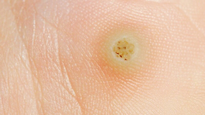Cancer de piel por papiloma