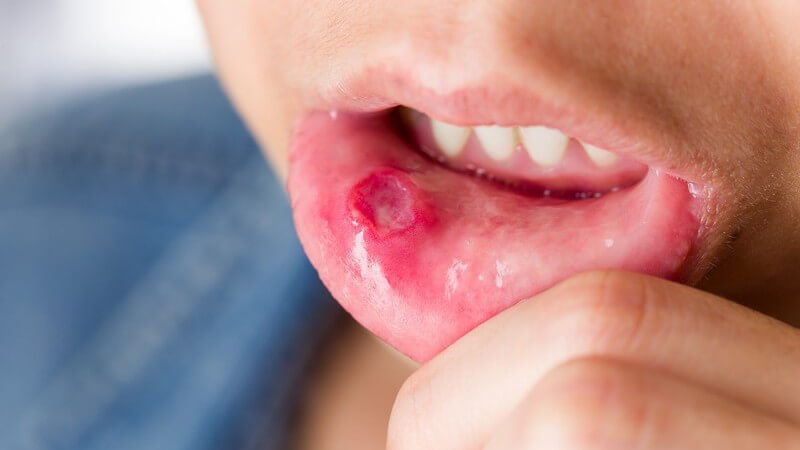 Die Erkrankung wird durch den Herpes simplex Typ 1 ausgelöst und betrifft Mundschleimhaut und Zahnfleisch