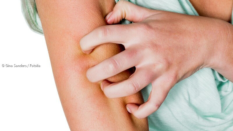 ᐅ Ringelflechte Tinea Corporis Ubertragung Symptome Und Behandlung