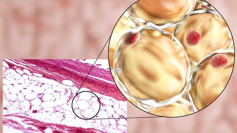 Chronische Fettverteilungsstörung an Armen und Beinen