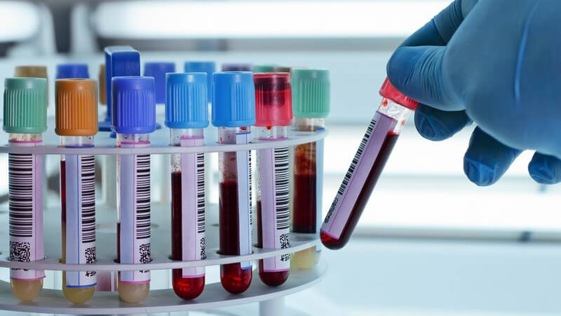 Ein Test zur Bestimmung von für Glutenunverträglichkeit typische Antikörper im Blutserum