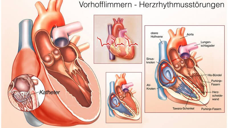 Wissenswertes zur absoluten Arrhythmie