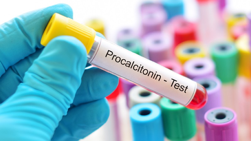 Blutprobe für einen Procalcitonin-Test