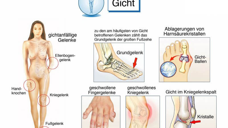 Wissenswertes zu Harnsäure