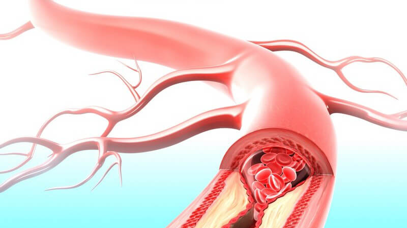 LDL gilt als "schlechtes" Cholesterin