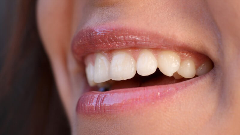 Wissenswertes zu Veneers