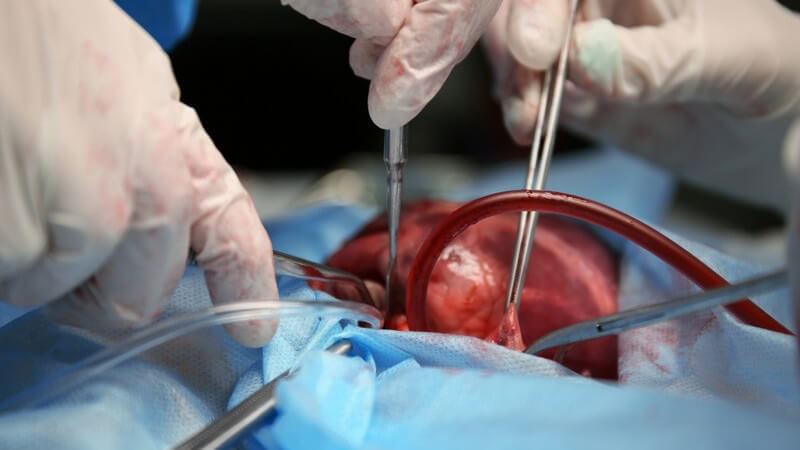 Wissenswertes zur Operation bei einer Herztransplantation
